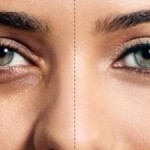 درمان تیرگی زیر چشم در چیست؟+عکس