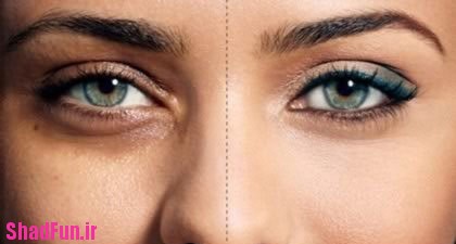 درمان تیرگی زیر چشم در چیست؟+عکس,درمان تیرگی زیر چشم در چیست,تیرگی زیر چشم, سیاهی دور چشم, علل تیرگی زیر چشم, چشم, کبودی زیر چشم