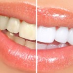 روش هایی برای سفید کردن دندان ها در منزل